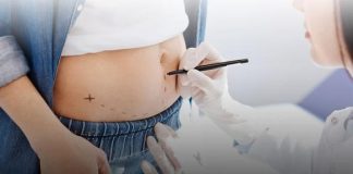 CoolSculpting