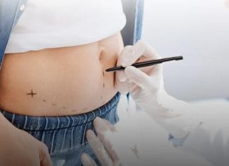 CoolSculpting